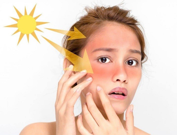 Những cách điều trị và phòng tránh nám da ở phụ nữ